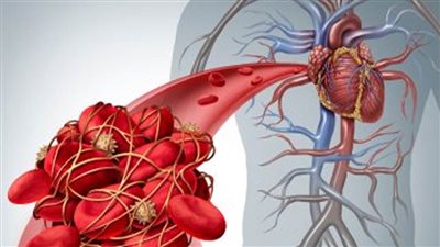 الاعتماد والرقابة الصحية تطلق فيديو تعريفيا بطرق الحد من الجلطات الوريدية