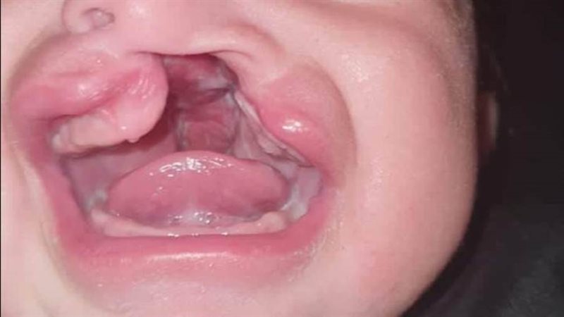 الشفة الأرنبية