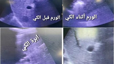 إضافة تقنيات جديدة ومتطورة بوحدة الأشعة التداخلية بمستشفى سوهاج الجامعي