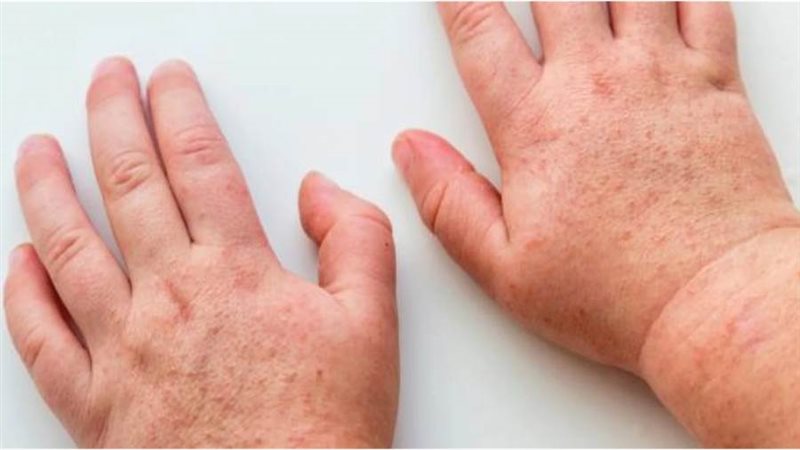 الحمى القرمزية