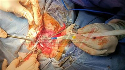   فريق طبي بمستشفى العبور ينجح في استئصال حنجرة مريض يعاني من ورم