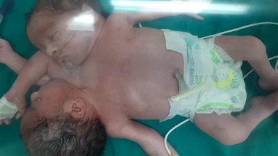 رأسان وجسم واحد.. نجاح ولادة توأم ملتصق بمستشفى جامعة المنصورة