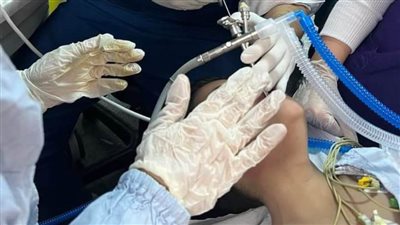 بنها الجامعي ينجح في إنقاذ حياة طفل يعاني من ورم بين الأحبال الصوتية 