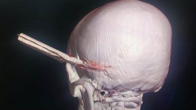 اختراق المبرد للجمجمة