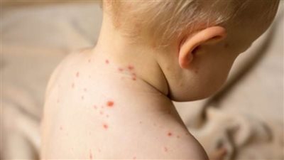 جنوب إفريقيا تصعد إجراءات مكافحة الحصبة عقب ارتفاع في معدلات الإصابة 