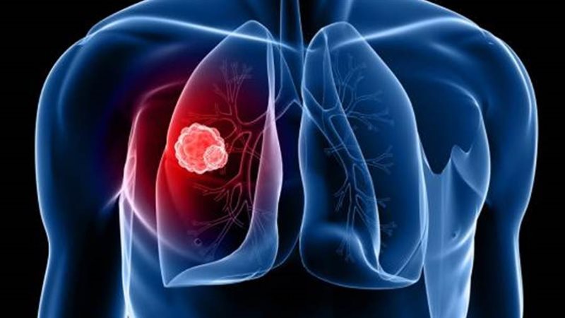 سرطان الرئة - ارشيفية