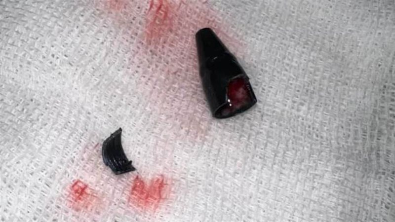 طفل يبتلع قطعة قلم