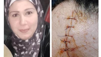 سيدة تستغيث بعد تعدي أسرة زوجها عليها: أصابوني بـ14 غرزة بسبب الميراث 