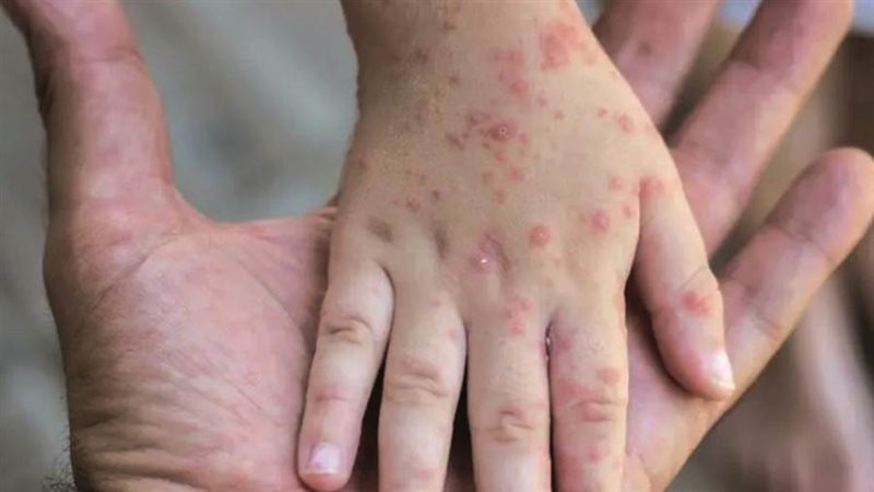 إصابات جديدة بجدري