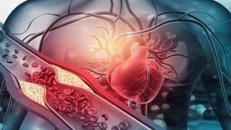 تصلب الشرايين