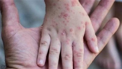 المركز الأوروبي للأمراض: ارتفاع الإصابات بجدري القردة إلى أكثر من 25 ألف حالة