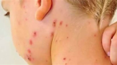 تسجيل أول حالة حصبة في ولاية مين الأمريكية منذ عام 2019