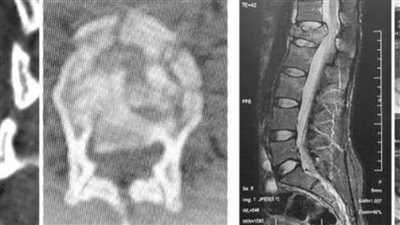 جراحة عاجلة لتثبيت الفقرات الصدرية والقطنية وتوسيع القناة العصبية