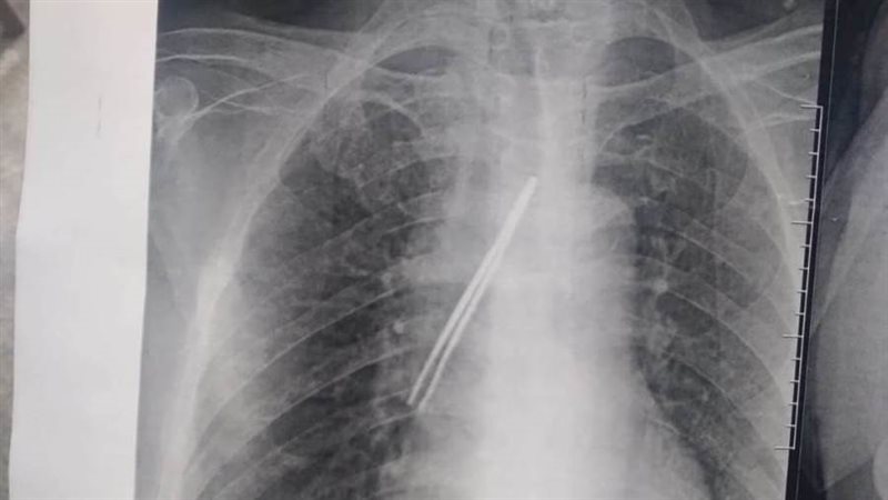 ملقاط بالقصبة الهوائية