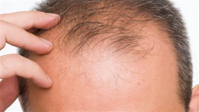 عاجل| دراسة تكشف عن دواء يعالج الصلع ويعيد 80% من الشعر 