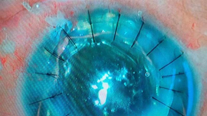 زراعة قرنيتين لمريضين