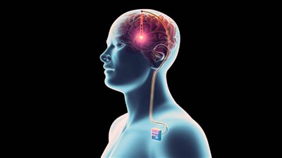 دراسة أمريكية: تقنية التحفيز العميق للدماغ قد تساعد في علاج السكتات الدماغية