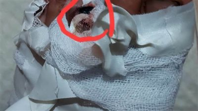 إهمال طبى بمركز متخصص يتسبب فى بتر إصبع قدم شاب فى الخانكة