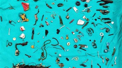 أطباء يستخرجون 60 قطعة منزلية من أمعاء رجل هندى