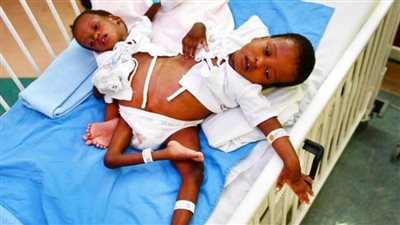 إجراء عملية فصل التوأم السيامي التنزاني 