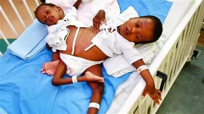 نجاح عملية فصل التوأم السيامي التنزاني 