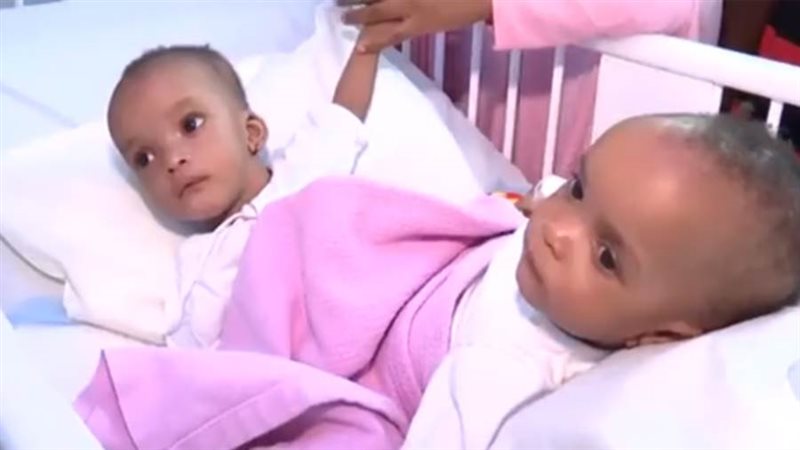 التوءم السيامي النيجيري