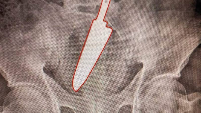 السكين داخل جسم المريض