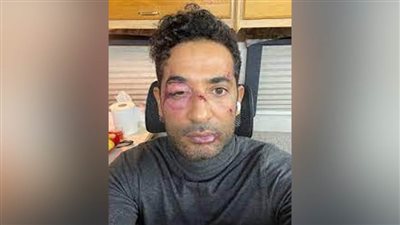 عمرو سعد يرد على شائعة صورته المنتشرة إثر حادث