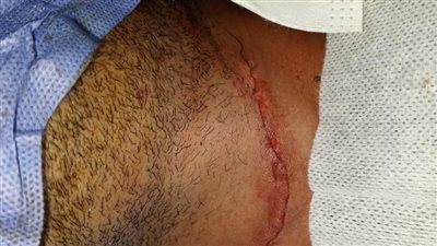 مستشفى جامعة سوهاج ينجح في إنقاذ حياة شاب تعرض لقطع في الشرايين الأمامية للرقبة