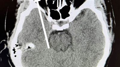 مستشفى سوهاج الجامعي تنقذ عاملًا من عمى محقق بعد إصابته بشظية في الشبكية 