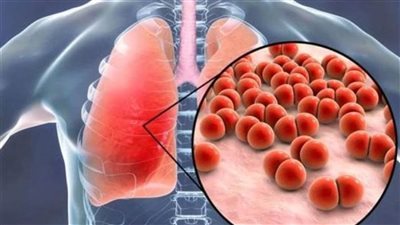 حالات الإصابة بالسل هي الأعلى في الولايات المتحدة خلال عقد من الزمن