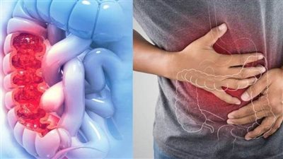 عاجل.. أربعة أخطاء لابد من تجنبها لتقليل خطر الإصابة بسرطان القولون