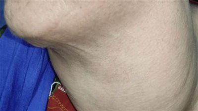 استئصال ورم سرطاني يزن١٨٠٠ جرام لسيدة أربعينية بمستشفى سوهاج الجامعي