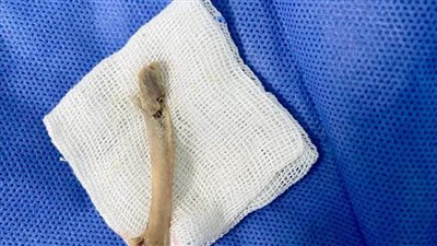 أطباء بجامعة الوادي الجديد ينجحون في استخراج عظمة من حنجرة مريض