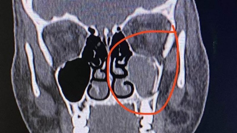 صورة أشعة لطفلة مصابة