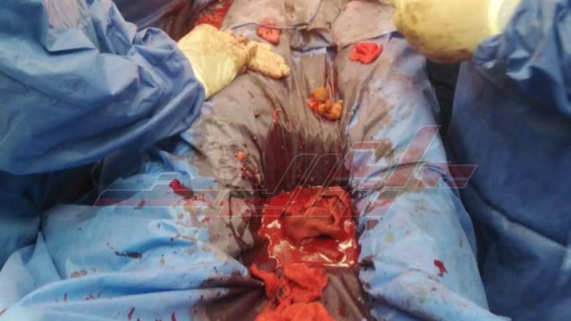 العملية الجراحية