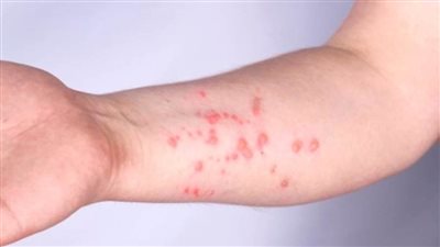 ارتفاع الإصابات والوفيات بعدوى جدري القرود بـ