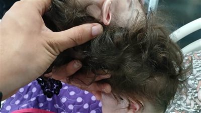 للمرة الأولى بجامعة الإسكندرية...إجراء عملية نادرة لفصل توأم ملتصق عن طريق الرأس