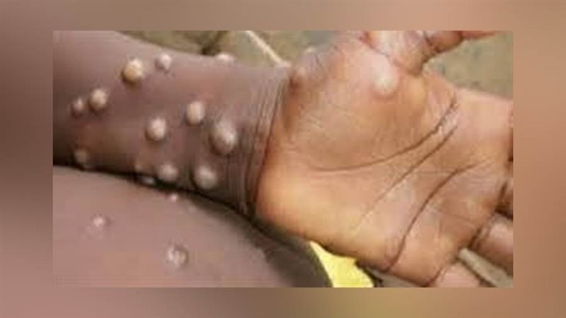 فيروس جدري القرود