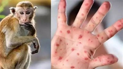 انخفاض مخاطر الإصابة بجدري القرود في سنغافورة