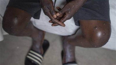 «الصحة» السعودية لم ترصد حالات مصابة بـ«جدري القردة»