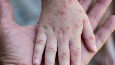 هيئة الصحة السعودية: المملكة خالية من فيروس جدري القرود Mpox حتى الآن