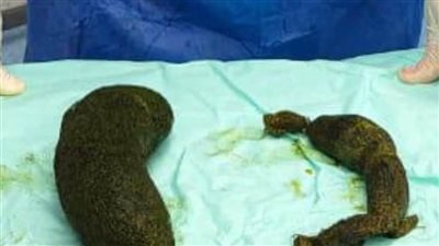 عاجل.. بتاكل شعرها.. فريق طبي يستخرج كتل شعرية من معدة فتاة في جراحة نادرة