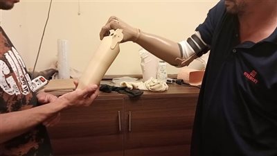 تسليم 10 أطراف صناعية لذوي الاحتياجات الخاصة بالدقهلية 