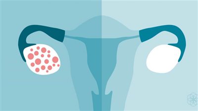 خبير: تكيسات المبيض أكثر الاضطرابات الهرمونية شيوعا وليست مجرد مرض