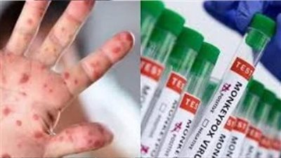 المراكز الإفريقية لمكافحة الأمراض: تسجيل 50 حالة وفاة بفيروس جدري القرود الأسبوع الماضي