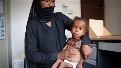 زيادة مثيرة للقلق في معدلات سوء التغذية في منطقة بحيرة تشاد