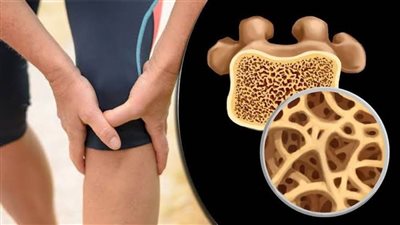 هشاشة العظام: المرض الصامت الذي يهدد صحة العظام عالميًا