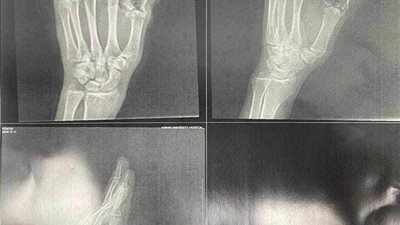 فريق طبي بمستشفى جامعة أسوان ينجح في إعادة أصابع يد شاب بعد بترها