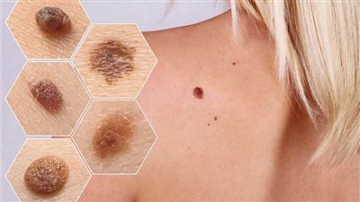 للوقاية من سرطان الجلد.. تعرف على طرق الحماية والاكتشاف المبكر